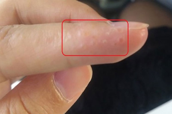 Bệnh Tổ Đỉa Ở Tay: Nguyên Nhân Và Cách Chữa Trị Hiệu Quả 3 Tổ đỉa trên đầu ngón tay
