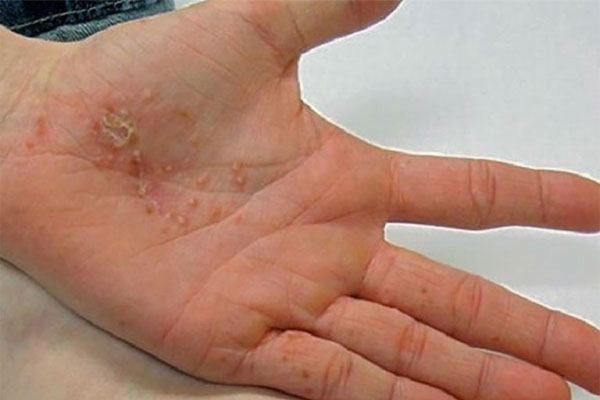 Bệnh Tổ Đỉa Ở Tay: Nguyên Nhân Và Cách Chữa Trị Hiệu Quả 6 Bệnh chàm ở lòng bàn tay