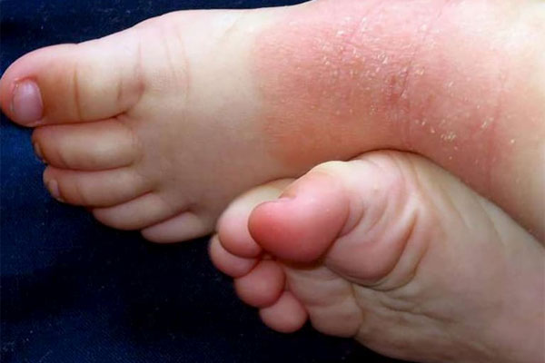 Bị vảy nến ở chân tay không gây nguy hiểm sức khỏe nhưng làm mất tính thẩm mỹ