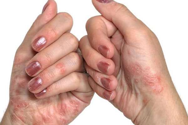 Triệu chứng của bệnh là các nốt mẩn đỏ hoặc mụn mủ