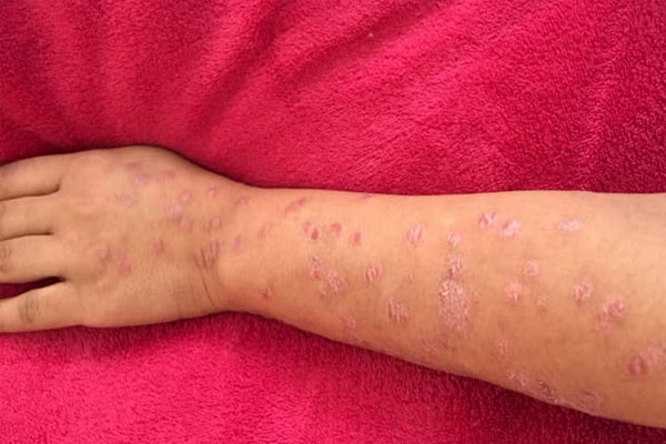 Bệnh vảy nến tay chân có nhiều triệu chứng khác nhau