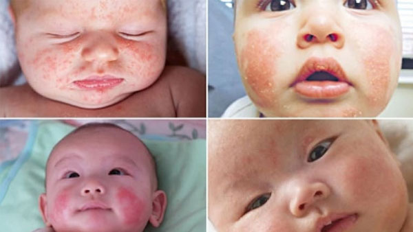 Bệnh chàm đỏ thường xuất hiện ở trẻ em, gây ngứa ngáy khó chịu
