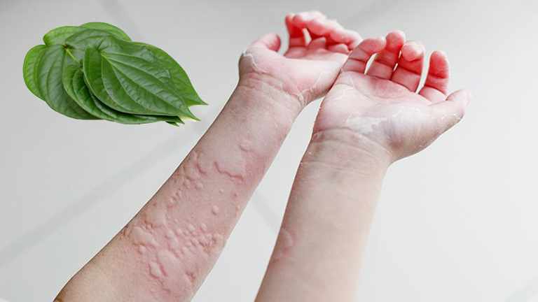 Chữa Mề Đay Bằng Lá Trầu: 4 Cách Đơn Giản Mà Hiệu Quả 2023 1 Chữa mề đay bằng lá trầu là phương pháp được áp dụng từ lâu và cho đến nay vẫn còn rất hiệu nghiệm
