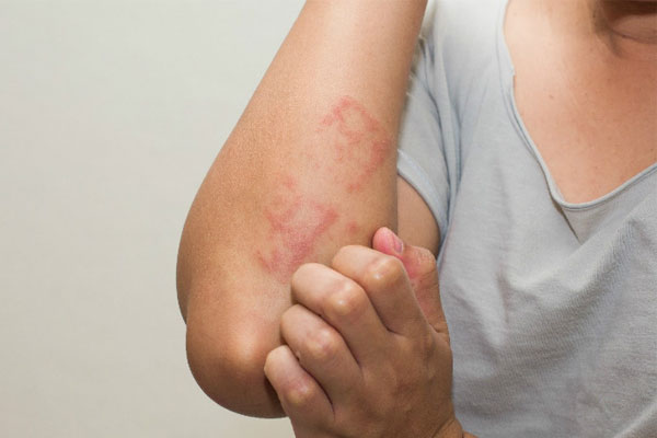 Giun sán là nguyên nhân chính dẫn đến ngứa da