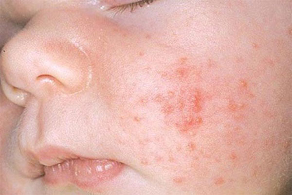 Nó có thể được gây ra bởi dị ứng