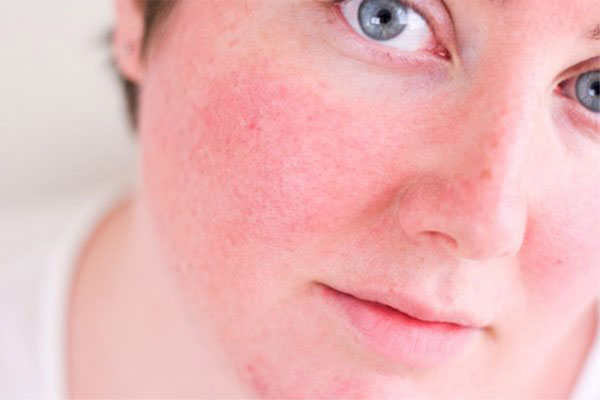 Hình ảnh da nhiễm corticoid