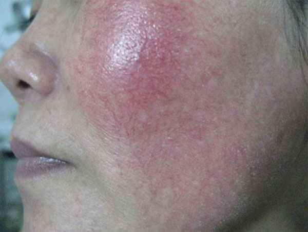 Da bị giãn mao mạch do nhiễm corticosteroid