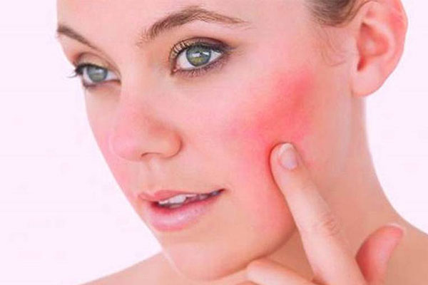Da bị nhiễm corticoid nên dùng thuốc gì thì tốt?
