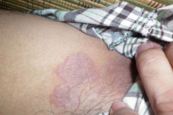 Hắc Lào Ở Háng: Cách Nhận Biết Sớm Và Điều Trị Khỏi Hẳn 1 Bệnh hắc lào ở háng là bệnh gì, có nguy hiểm hay không?