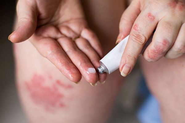 Hắc Lào Ở Háng: Cách Nhận Biết Sớm Và Điều Trị Khỏi Hẳn 6 Tây y có một số loại thuốc bôi và thuốc uống để điều trị căn bệnh này