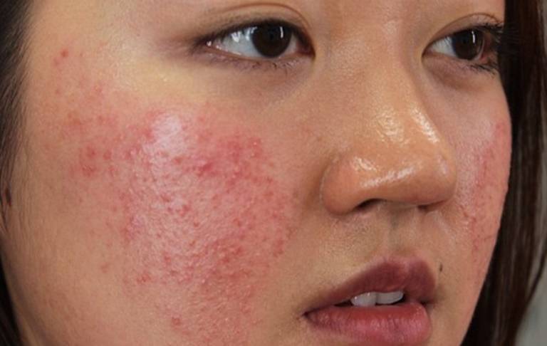 Da Mặt Bị Ngứa Và Nổi Mụn: Nguyên Nhân & Cách Điều Trị 2023 3 Mặt nổi mụn do viêm da cơ địa