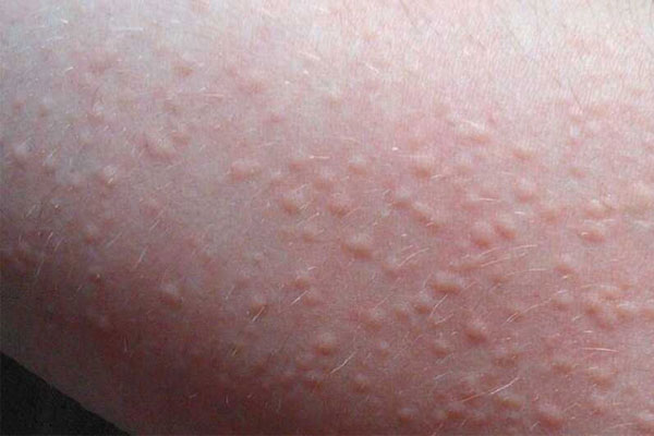 Người bị nổi mề đay sẽ cảm thấy nóng, ngứa và châm chích