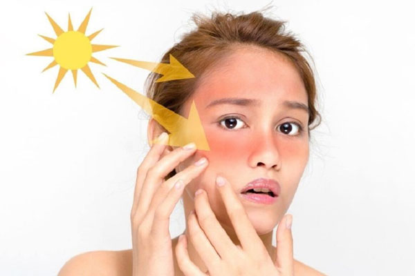 Nhiệt độ cao là nguyên nhân chính gây mề đay choline