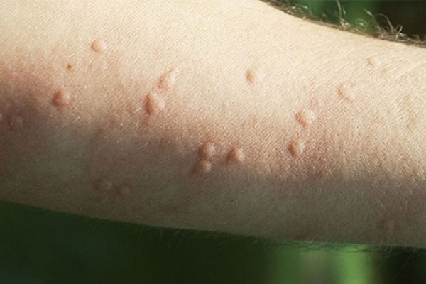 Mề đay cholinergic được chia thành 4 loại khác nhau