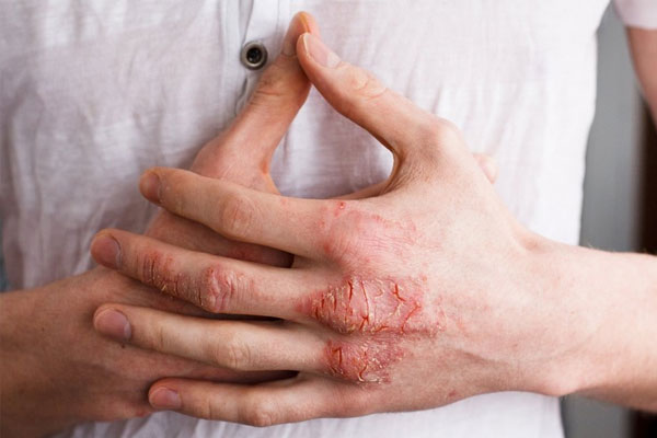 Viêm da tiếp xúc cũng là một nguyên nhân gây ra bệnh