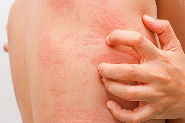 Ngứa da là một vấn đề về da khiến nhiều người khó chịu và mất tập trung
