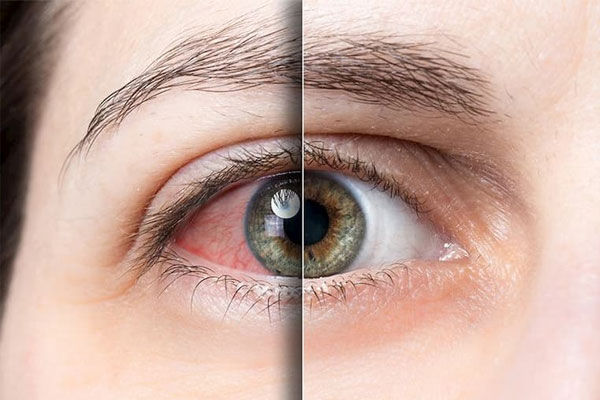 Dị ứng cũng là nguyên nhân gây ngứa mắt