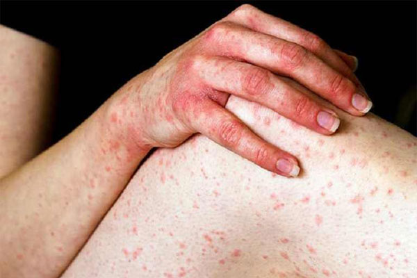 Thuốc Hivers giúp làm lành vết thâm trên da do dị ứng, mề đay