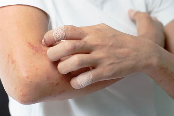 Sản phẩm dùng cho bệnh chàm cơ địa