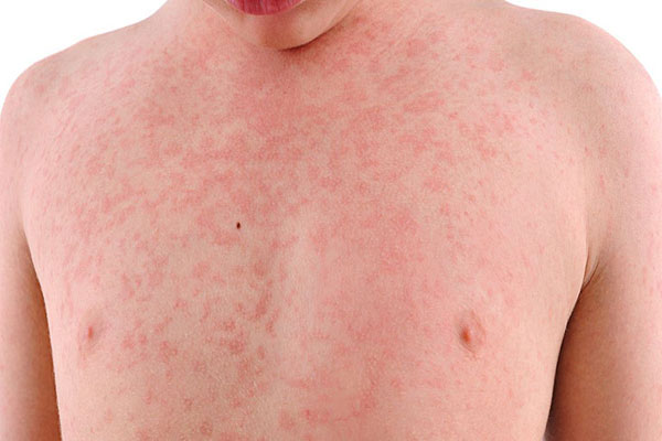 Trẻ Bị Nổi Mề Đay: Nguyên Nhân, Dấu Hiệu Và Cách Chữa Hiệu Quả 2 Toàn thân trẻ sẽ nổi các nốt sẩn đỏ, nóng và ngứa