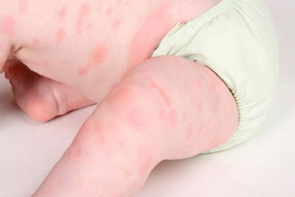 Trẻ Bị Nổi Mề Đay: Nguyên Nhân, Dấu Hiệu Và Cách Chữa Hiệu Quả 3 Tổ ong có màu đỏ hoặc hồng nhạt, có ranh giới rõ ràng với phần còn lại của da