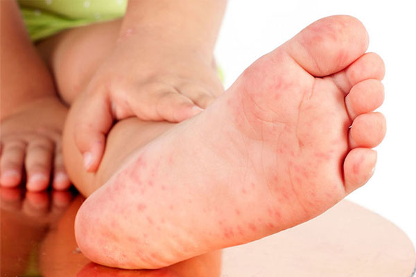 Trẻ Bị Nổi Mề Đay: Nguyên Nhân, Dấu Hiệu Và Cách Chữa Hiệu Quả 4 Vị trí phổ biến nhất của phát ban trên cơ thể là trên bàn tay và bàn chân