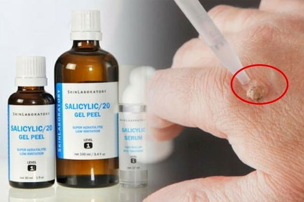 Vảy Nến Thể Giọt: Nguyên Nhân, Cách Điều Trị Nhanh Khỏi 2023 5 Axit salicylic được sử dụng để điều trị các bệnh ngoài da