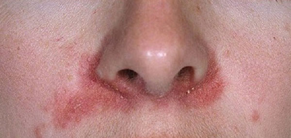 Viêm Da Dầu: Nguyên Nhân, Triệu Chứng Và Cách Điều Trị 3 Hình ảnh bệnh viêm da tiết bã ở hai cánh mũi.