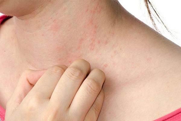 Bệnh viêm da dị ứng không lây từ người này sang người khác nhưng các tổn thương trên da có thể lan rộng toàn thân.