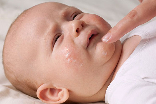 Thoa kem dưỡng ẩm để bổ sung độ ẩm chăm sóc da bé