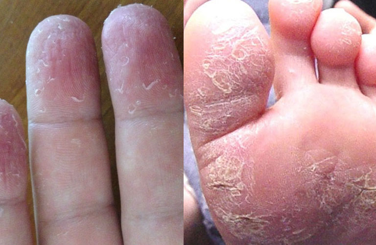 Các triệu chứng điển hình của á sừng là da khô, bong tróc