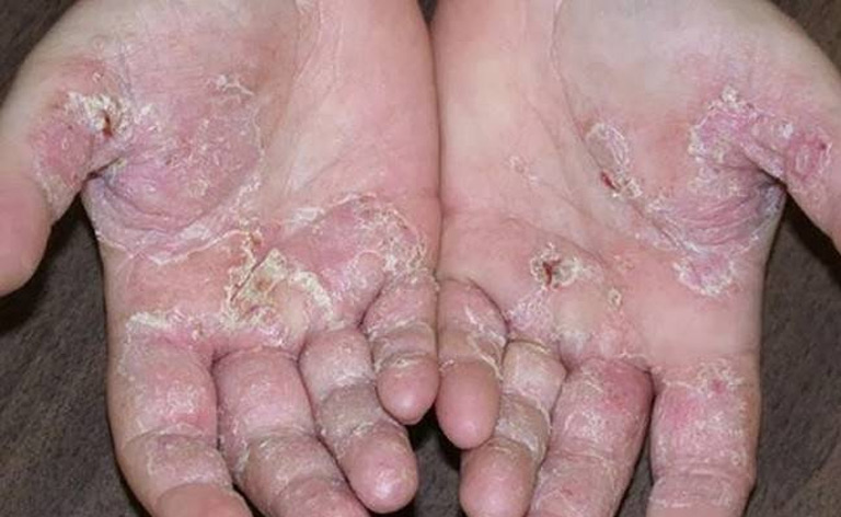 Bệnh á sừng liên cầu là gì?