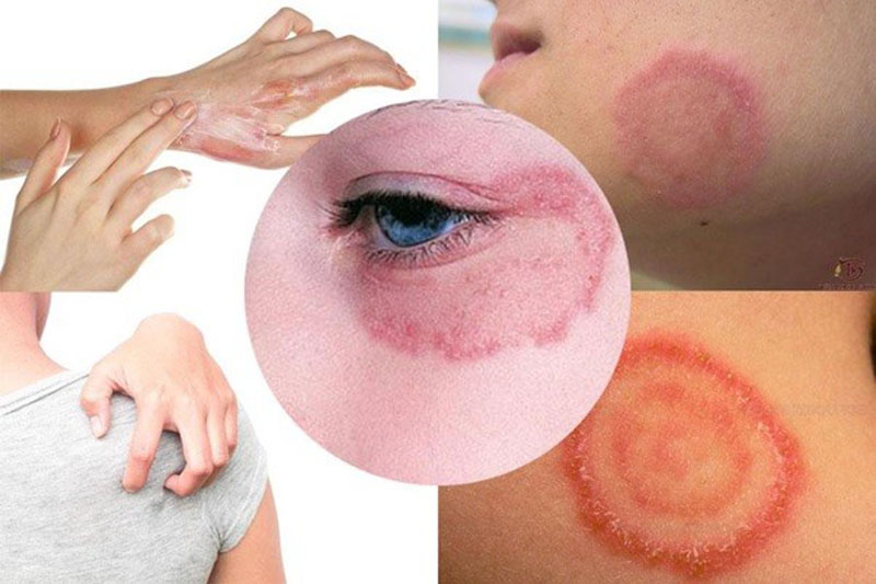 Vị trí mắc và dấu hiệu bệnh hắc lào
