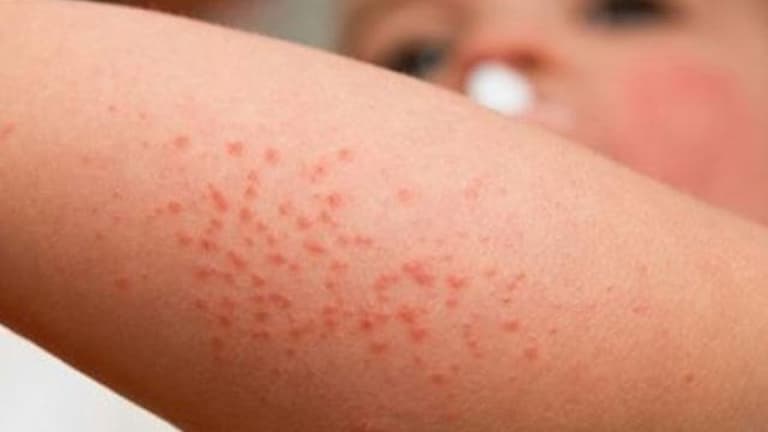 Da nổi mụn nước đỏ không ngứa là dấu hiệu đáng báo động về sức khỏe