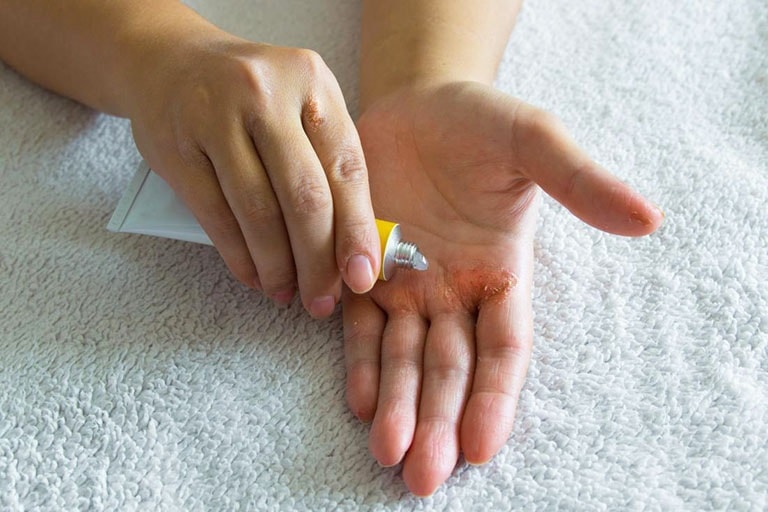 Một số thuốc bôi giúp ức chế hoạt động của nấm được khuyên dùng