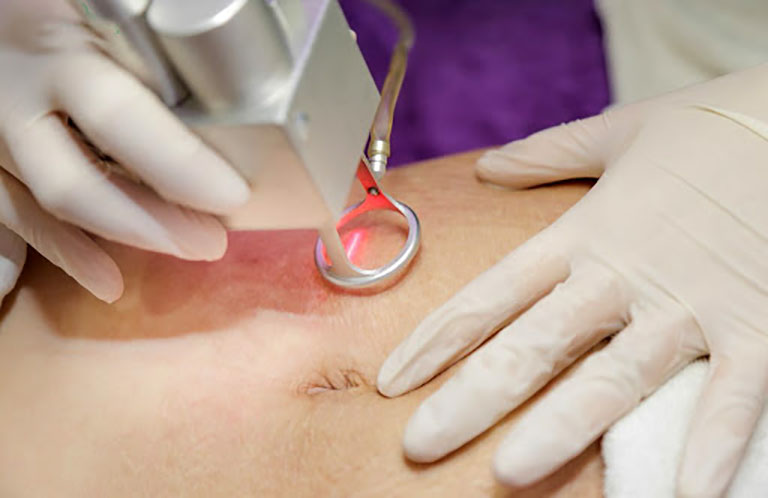 Rạn Da Là Gì? Nguyên Nhân, Biểu Hiện Và Cách Chữa 2023 5 Phương pháp laser thường được sử dụng để điều trị vết rạn da