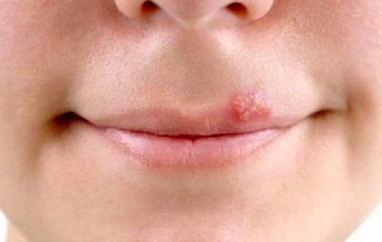 Nên đi khám khi mụn nước xuất hiện ở những vị trí nguy hiểm