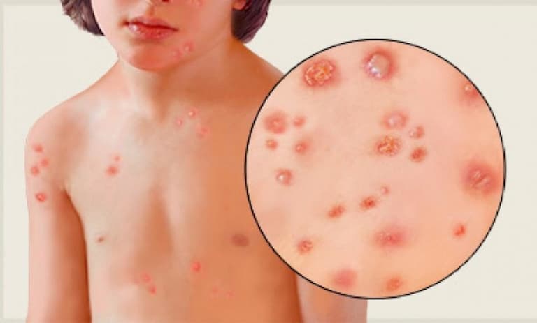 Thủy đậu cũng được xem là nguyên nhân nổi mụn đỏ không ngứa