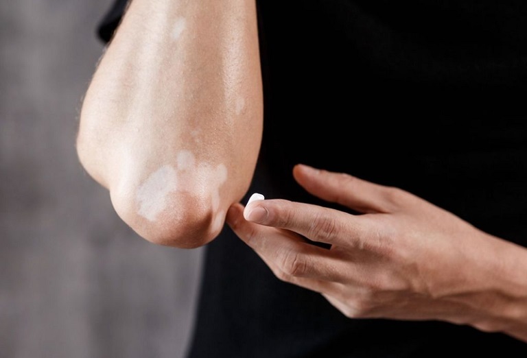 Trị Lang Ben Tại Nhà Với 15 Mẹo Hay Khỏi Ngay Không Cần Thuốc 1 Trị lang ben: Mẹo hay không cần dùng thuốc có thể chữa khỏi tại nhà