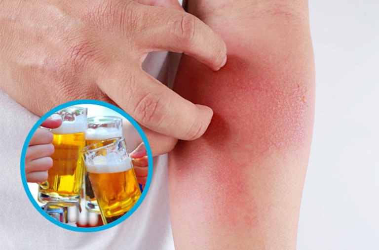 Uống Rượu Nổi Mề Đay Có Nguy Hiểm Không? Cách Xử Lý 2023 1 Uống rượu bia nổi mề đay không phải hiện tượng hiếm gặp
