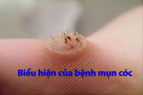 Mua thuốc trị mụn cóc tại Thái Bình 1
