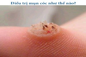 Mua thuốc trị mụn cóc tại Hải Phòng 7