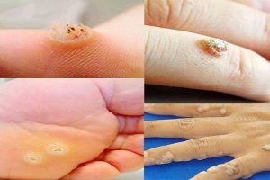 Mua thuốc trị mụn cóc tại Thái Bình 7