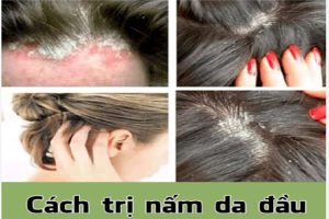 Mua thuốc trị nấm da đầu tại Hải Phòng 6