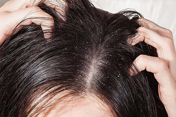 Mua thuốc trị nấm da đầu tại Thái Bình 1