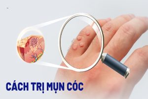 Mua thuốc trị mụn cóc tại Quảng Ninh 8