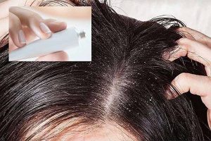 Mua thuốc trị nấm da đầu tại Quảng Ninh 8