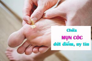 Mua thuoc tri mun coc tai Ben Tre