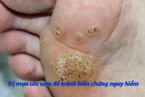 Mua thuốc trị mụn cóc uy tín tại Hải Dương 7