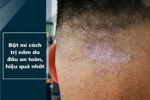 Mua thuốc trị nấm da đầu tại Bình Định 8